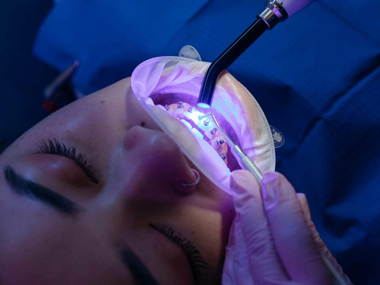 Отбеливание зубов Enlighten в стоматологической клинике Adadenta